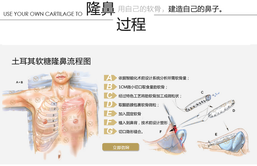 刘彦军土耳其软糖隆鼻怎么样?价格