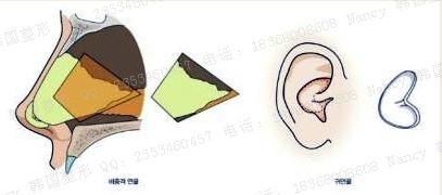 硅胶隆鼻、膨体隆鼻、自体软骨隆鼻哪个好?