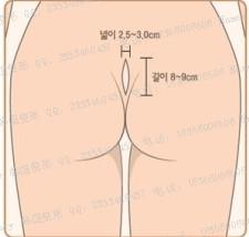 硅胶隆鼻、膨体隆鼻、自体软骨隆鼻哪个好?