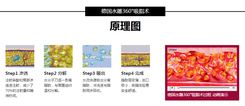北京京民王志坚吸脂怎么样?多少钱?