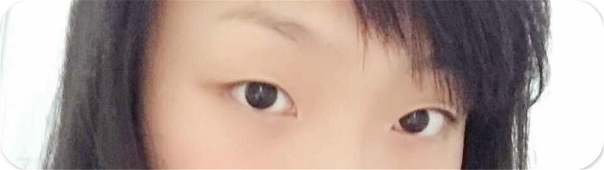 沈阳名流双眼皮术后案例