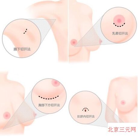 在胸部放入过大的假体材料会导致皮肤破裂吗?