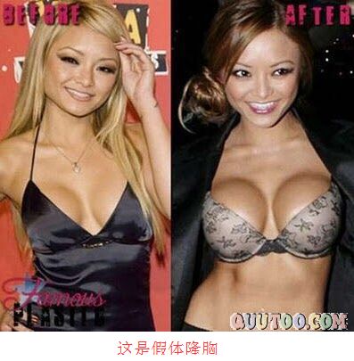 现今医疗技术做假体隆胸果怎么样?