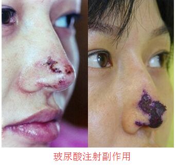 玻尿酸注射鼻尖导致血栓或者组织坏死 玻尿酸瑞蓝、润百颜、逸美之间有什么区别