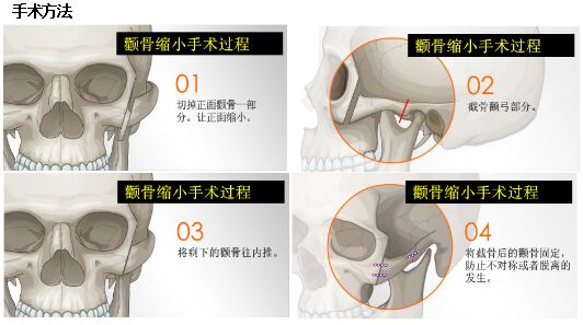磨颧骨整形手术方法 磨颧骨整形手术后会下垂吗?