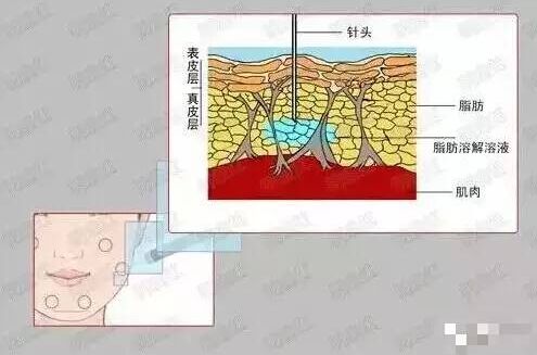 减脂原理 北京三元网-溶脂和吸脂的区别