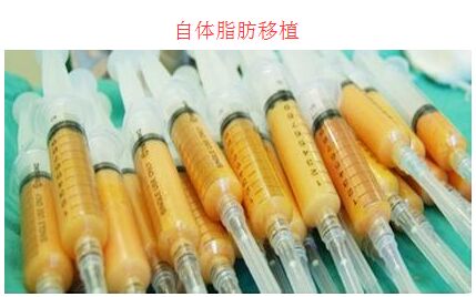 自体脂肪整形 关于部分自体脂肪移植的并发症