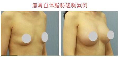 唐勇自体脂肪隆胸案例 北京八大处唐勇自体脂肪隆胸价格?好吗?