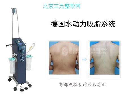 德国水动力设备和吸脂案例 水动力辅助吸脂用于自体脂肪移植隆胸的果