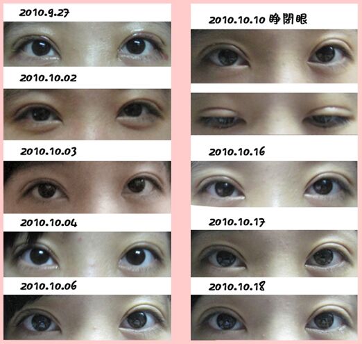 双眼皮案例 杭州117医院何冬梅双眼皮怎么样?