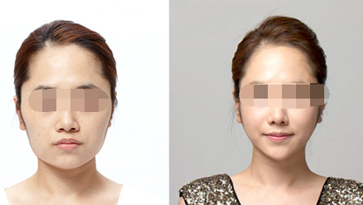 上海华美李志海磨骨怎么样?