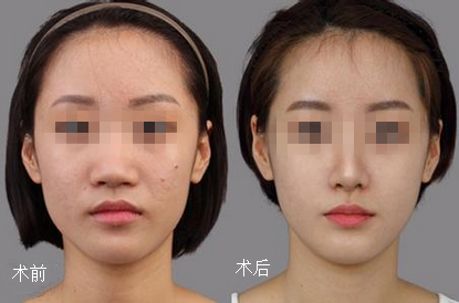 北京八大处李战强隆鼻怎么样?