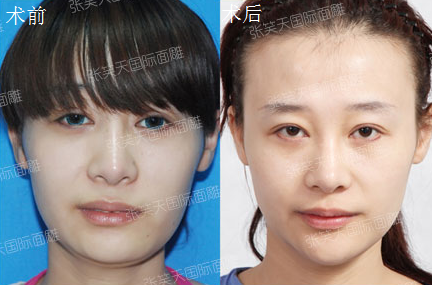 北京中日友好高占巍磨骨怎么样?技术好不好?