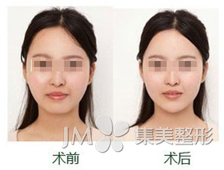 郑州集美玻尿酸填充下班案例 郑州集美玻尿酸丰下巴案例
