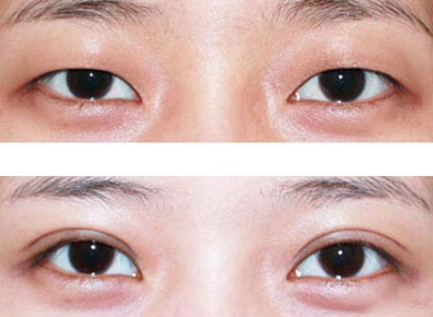 北京医院钱文江双眼皮怎么样?多少钱?