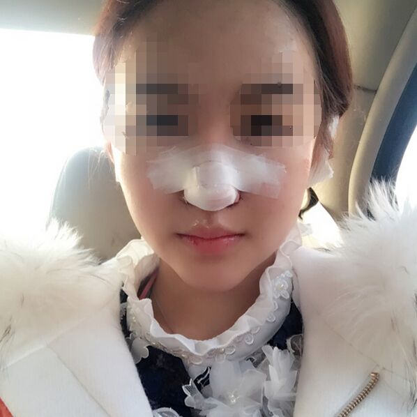 大家看看北京世纪坛医院徐光做的鼻子怎么样?