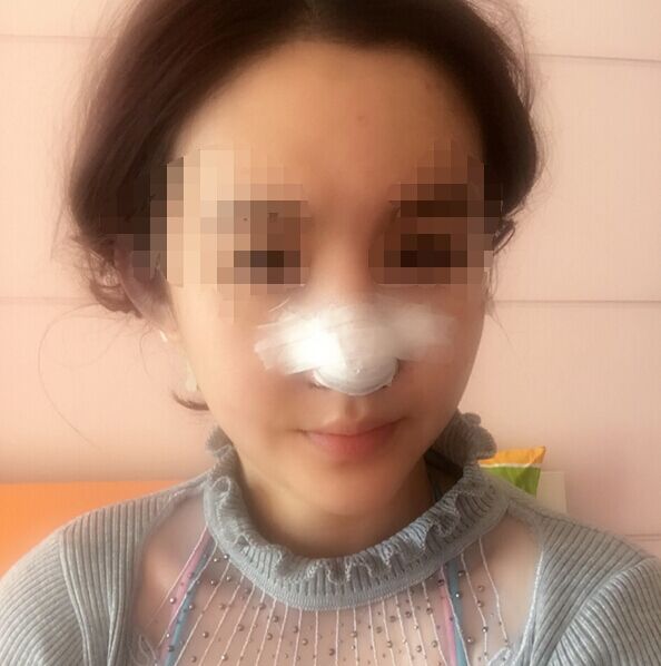 大家看看北京世纪坛医院徐光做的鼻子怎么样?