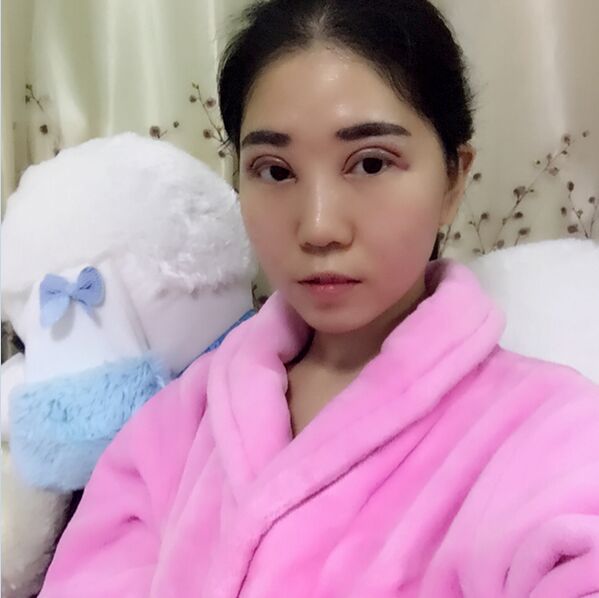 记录郑州孟明星双眼皮日记怎么样?