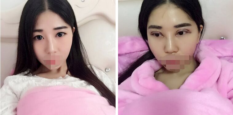 记录郑州孟明星双眼皮日记怎么样?