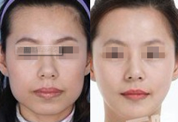 上海时光何晋龙磨骨怎么样?技术好不好?