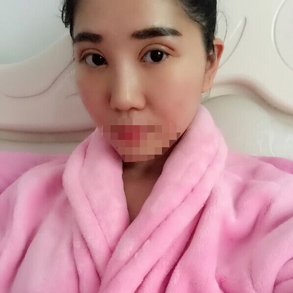 记录郑州孟明星双眼皮日记怎么样?