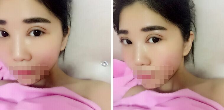 记录郑州孟明星双眼皮日记怎么样?