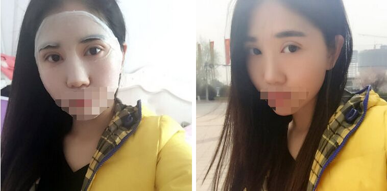 记录郑州孟明星双眼皮日记怎么样?
