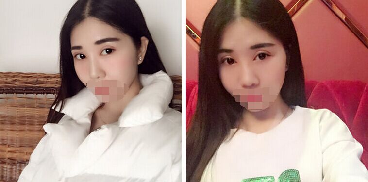 记录郑州孟明星双眼皮日记怎么样?