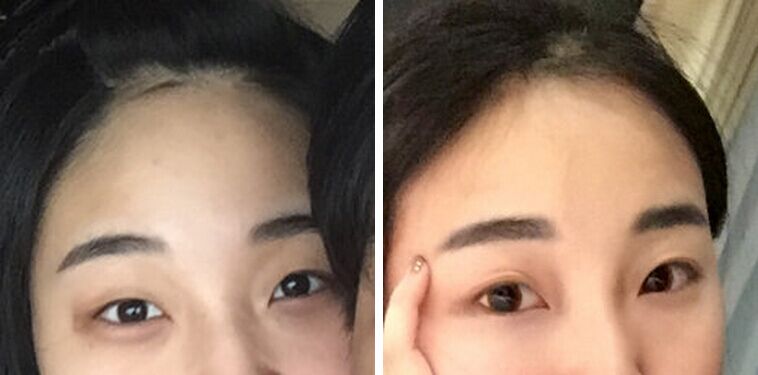 广州美莱田跃平双眼皮怎么样?案例!