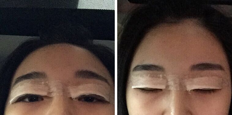 广州美莱田跃平双眼皮怎么样?案例!
