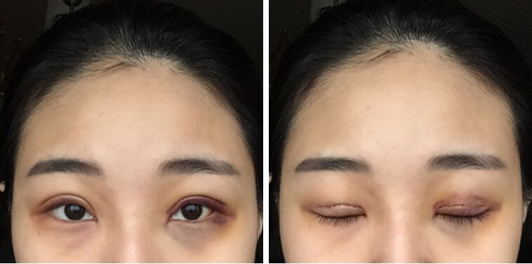广州美莱田跃平双眼皮怎么样?案例!