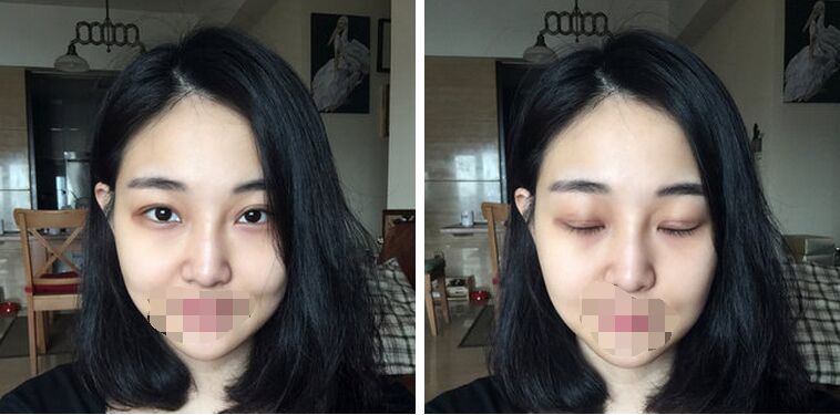 广州美莱田跃平双眼皮怎么样?案例!