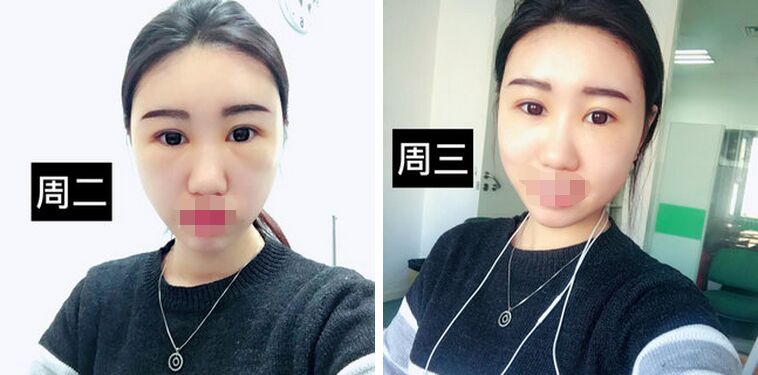 胡守舵自体脂肪面部填充案例怎么样?