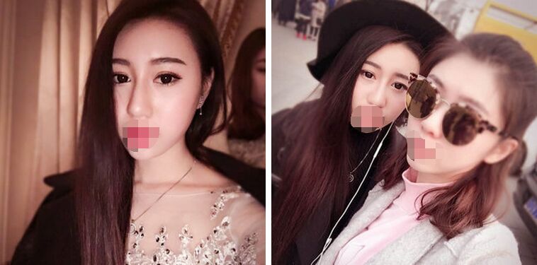胡守舵自体脂肪面部填充案例怎么样?