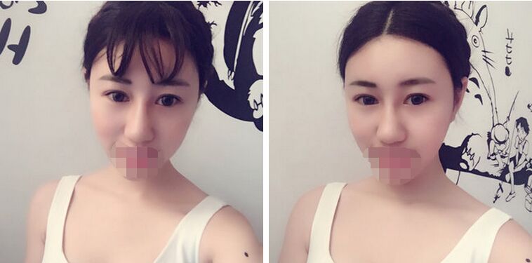 胡守舵自体脂肪面部填充案例怎么样?