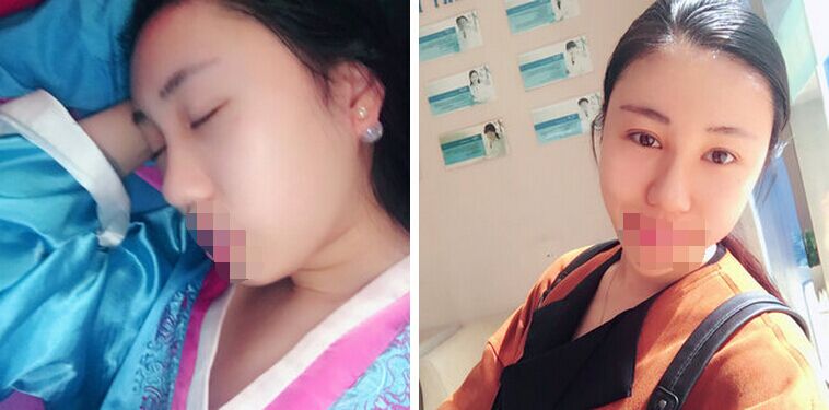 胡守舵自体脂肪面部填充案例怎么样?
