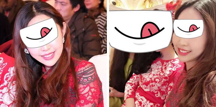 北京悦丽汇姚然玻尿酸丰下巴案例怎么样?