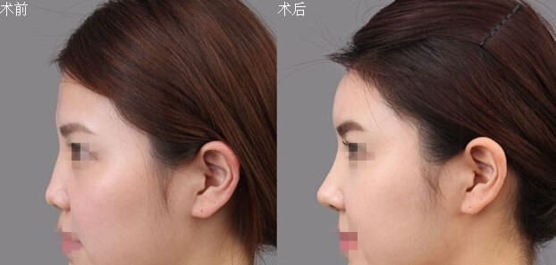 上海九院李青峰隆鼻技术好不好?