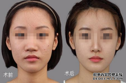 上海华美谢卫国隆鼻怎么样?好吗