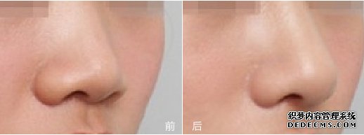 北京八大处王克明隆鼻怎么样?