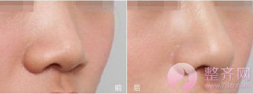 上海喜美做隆鼻怎么样?王会勇技术好不好?