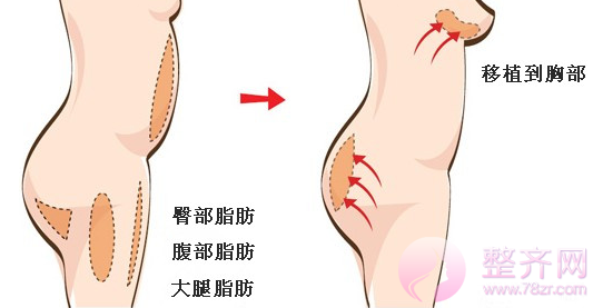 北京京韩王沛森自体脂肪隆胸怎么样?