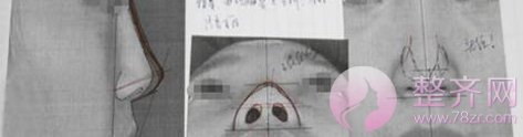上海百达丽王艳隆鼻果好不好?有没有案例?