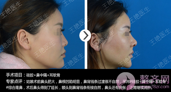 上海百达丽王艳隆鼻果好不好?有没有案例?