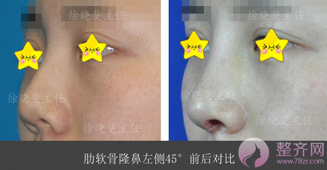 上海百达丽徐晓斐隆鼻怎么样?有没有案例?