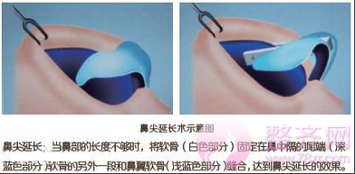 北京米扬丽格巫文云鼻部手术多少钱?有没有案例