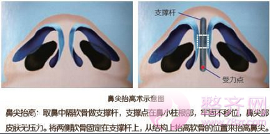 北京米扬丽格巫文云鼻部手术多少钱?有没有案例