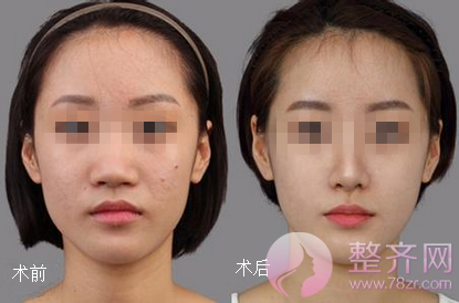 北京米扬丽格巫文云鼻部手术多少钱?有没有案例