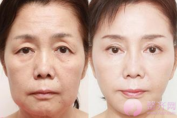 上海华美聂婕面部除皱怎么样?果好不好?