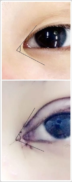 做双眼皮手术对面部的改变大吗？
